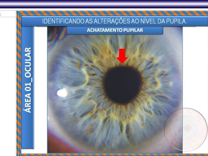 achatamento frontal olho iridologia em aracaju