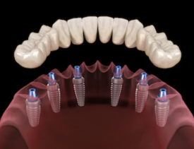 Prótese-fixa-sobre-implantes-dentários-e1592689015243