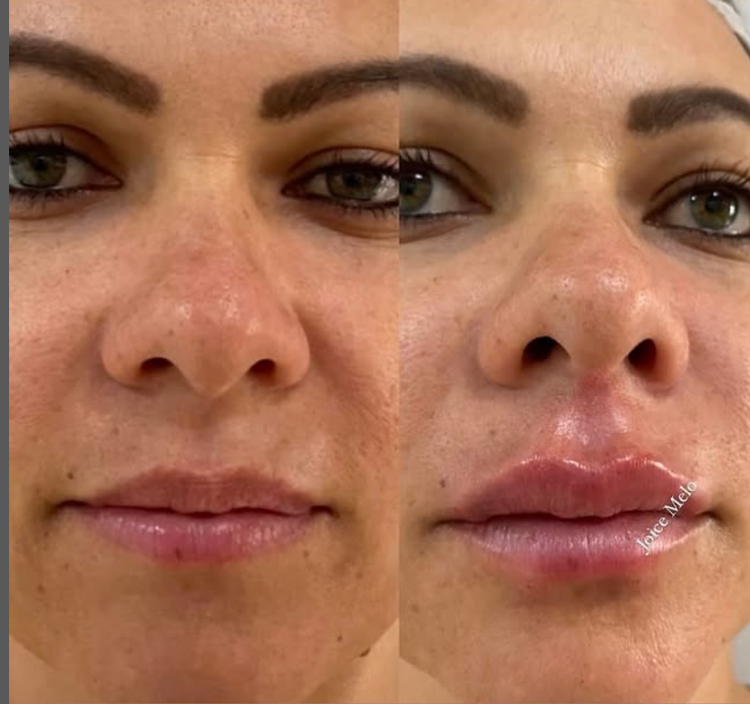 preenchimento labial 