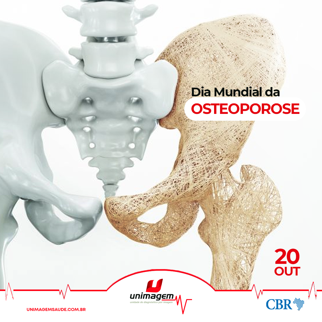 Fator Que Favorece O Surgimento Da Osteoporose