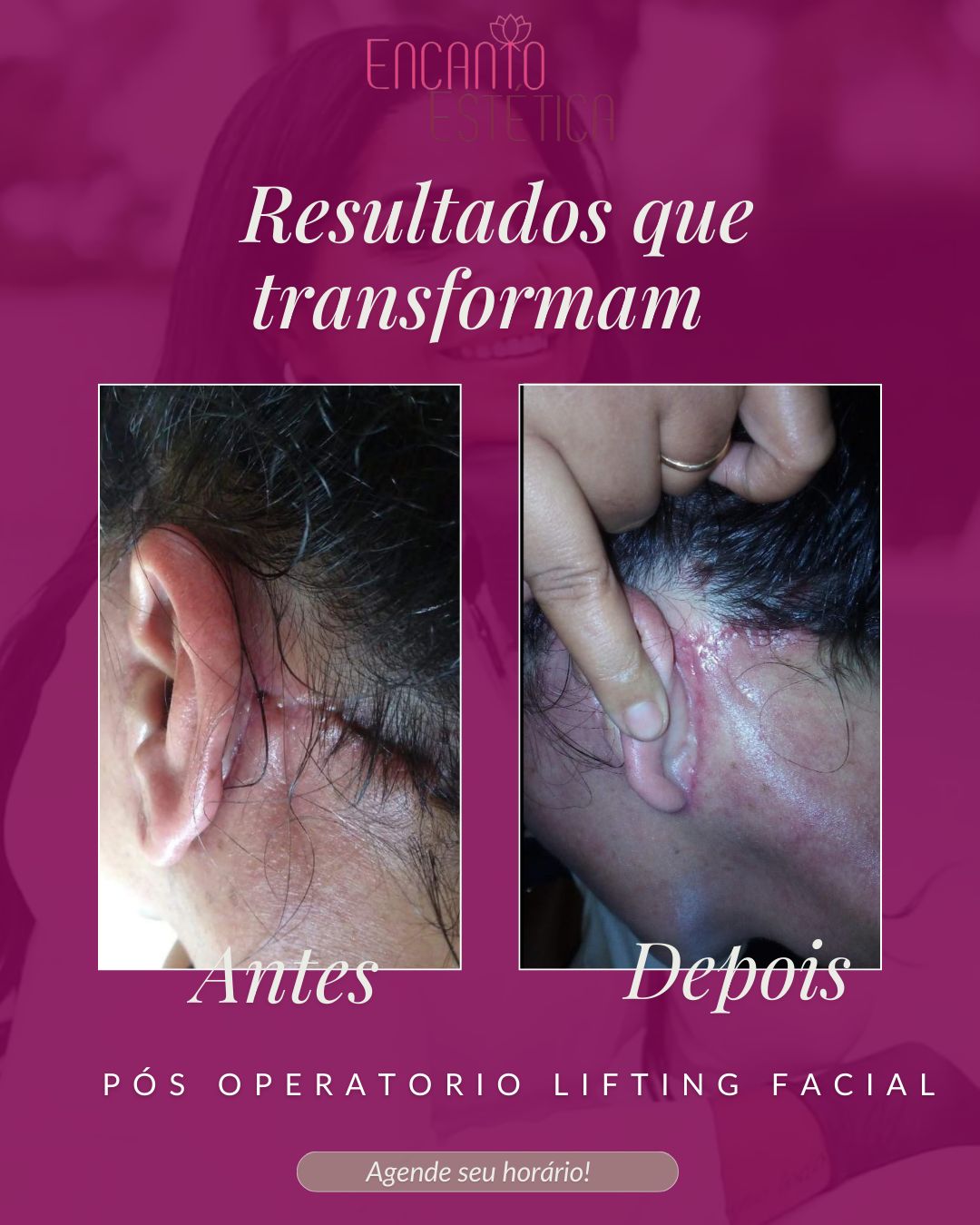 Pós operatório Lifting facial