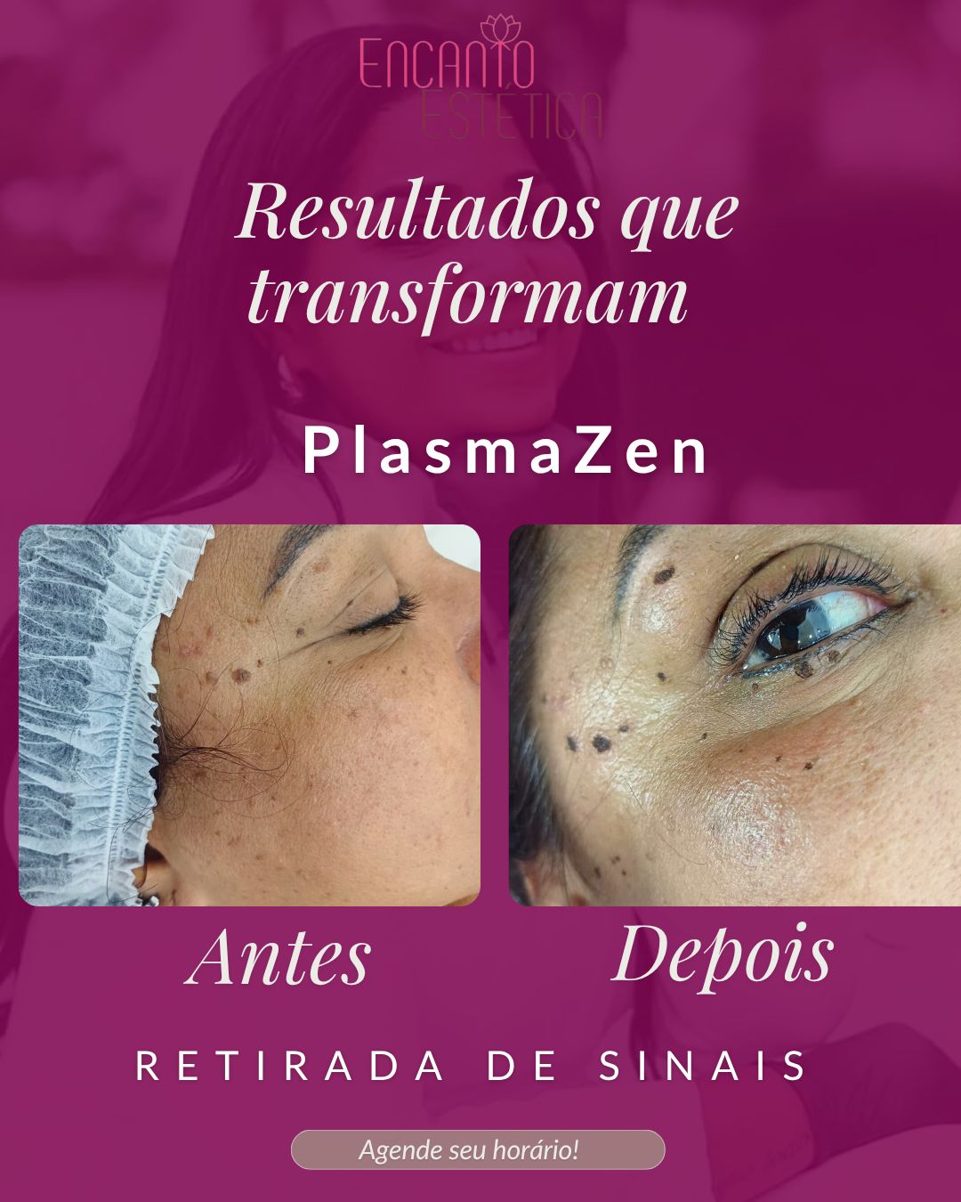 Retirada de Sinais - PlasmaZen