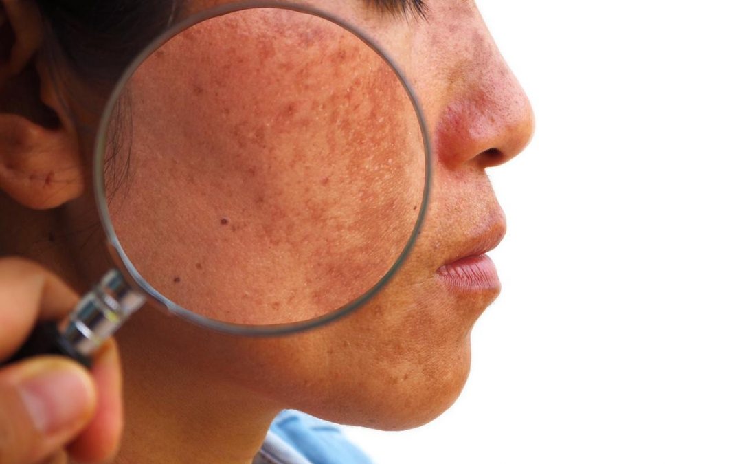 Imagem-Melasma-Blog-1080x675 Imagem-Melasma-Blog-1080x675