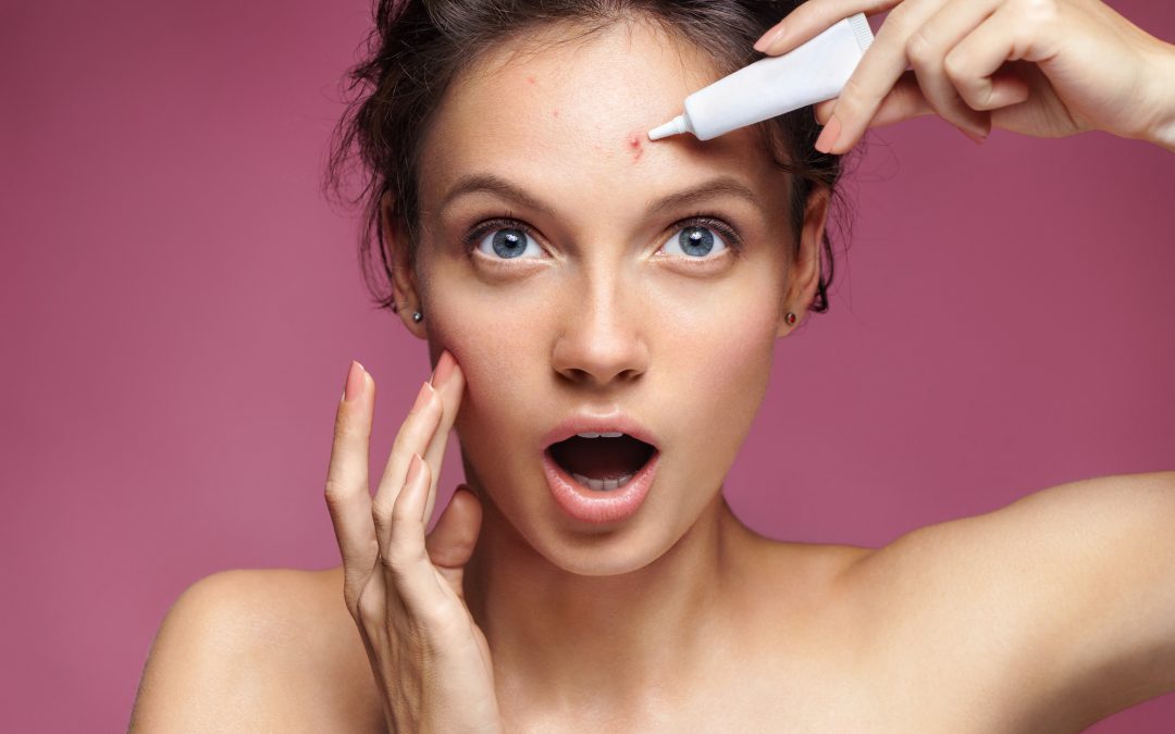 acne-1080x675 acne-1080x675